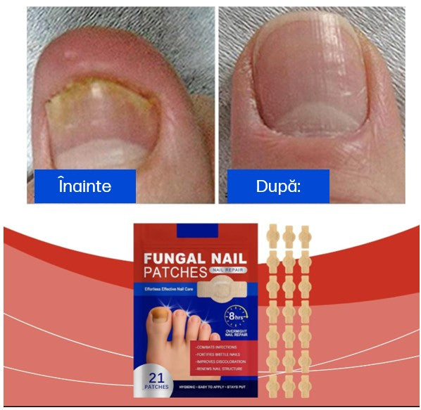 Plasturii Antifungici Pentru Unghii